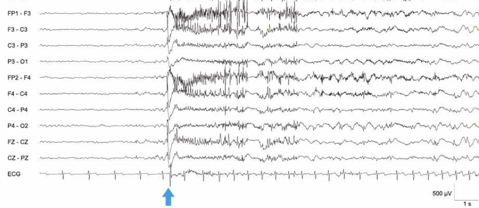 الگوی تشنج EEG ژنرالیزه - تشنج تونیک دوطرفه
