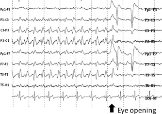 حساسیت به Fixation-off