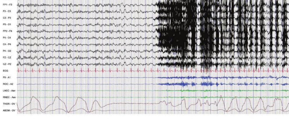 آپنه ایکتال