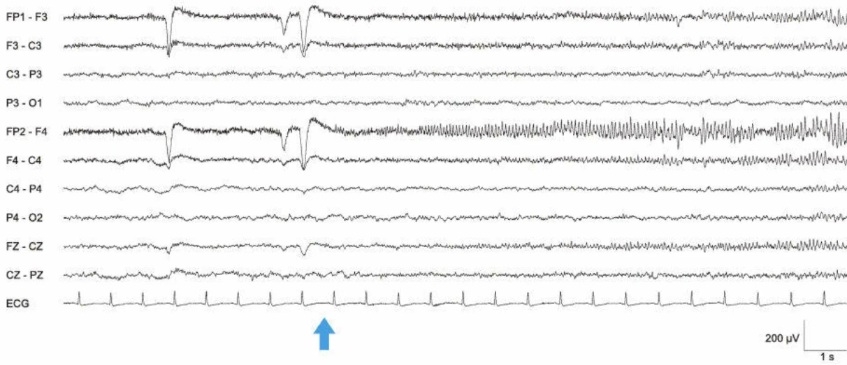 الگوی تشنج EEG فرونتوپولار راست