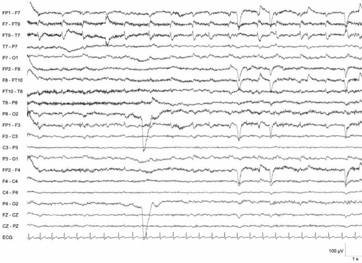 الگوی تشنج EEG، تمپورال میانی چپ (ادامه)