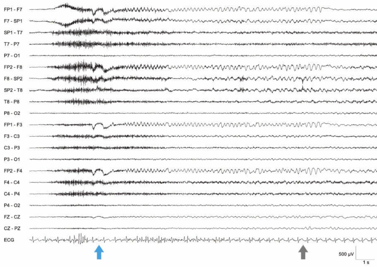 الگوی تشنج EEG فرونتال غیرلترالیزه