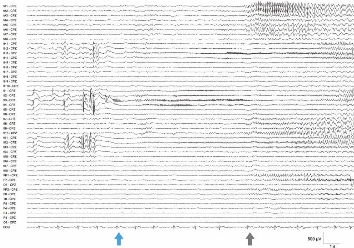 الگوی تشنج EEG تهاجمی