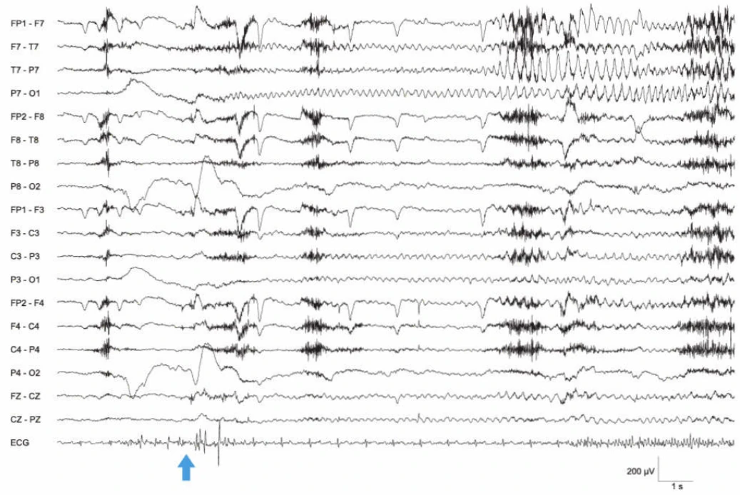 الگوی وضعیت EEG، تمپورال چپ