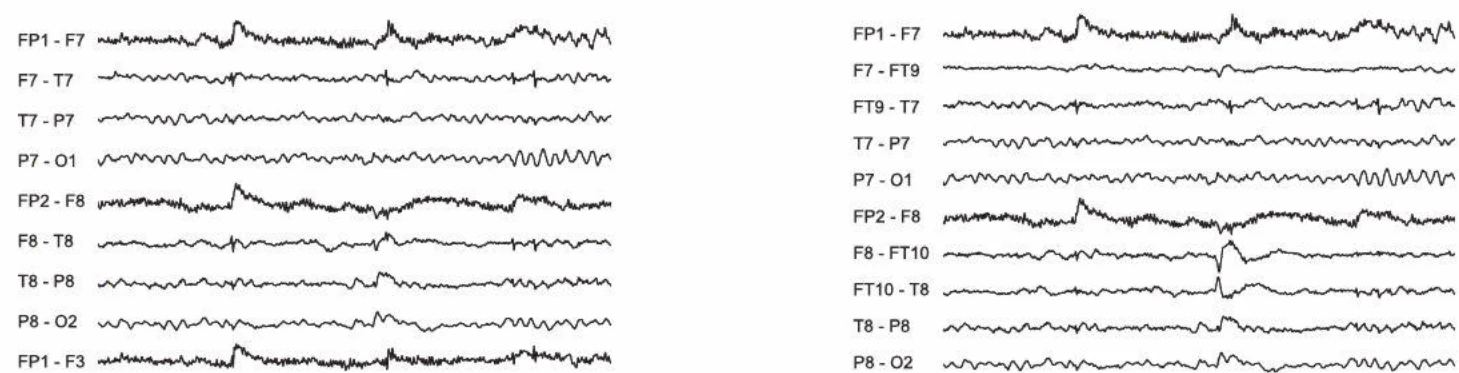 الکترودهای تمپورال قدامی