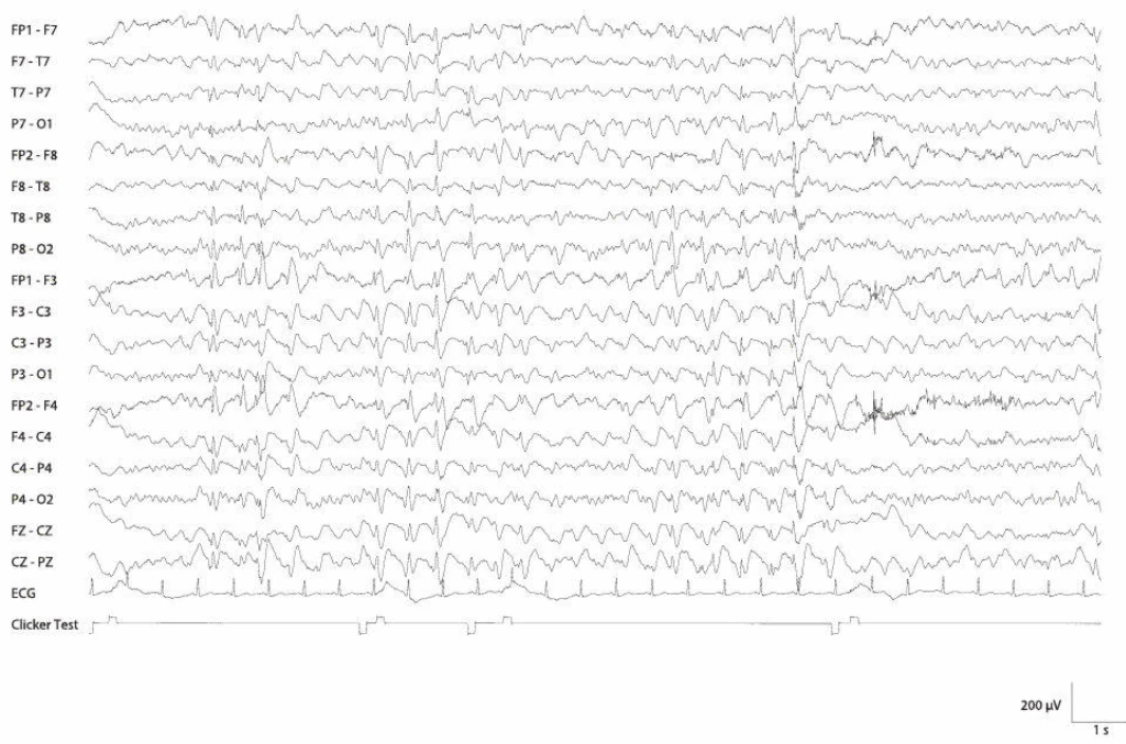 اسپایک-ویوهای آهسته، ژنرالیزه