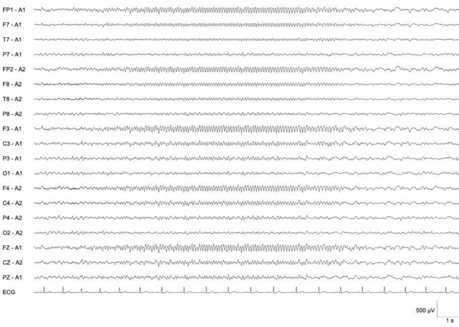 استاتوس اپیلپتیکوس EEG، استاتوس دیالپتیک