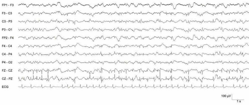 استاتوس اپیلپتیکوس EEG، مید-سنترال