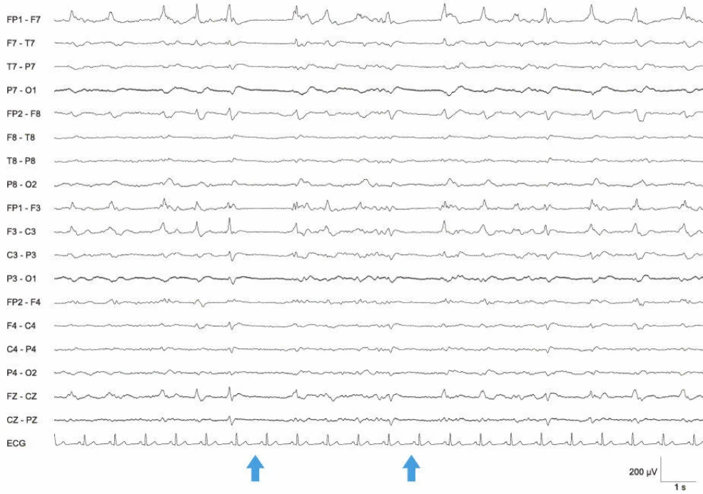 الگوی وضعیت EEG، فرونتال چپ؛ کمای دلتا
