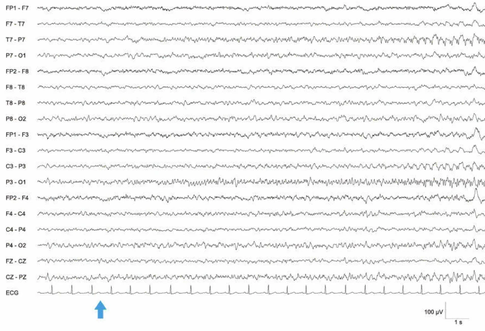 الگوی وضعیت EEG، اکسیپیتال چپ