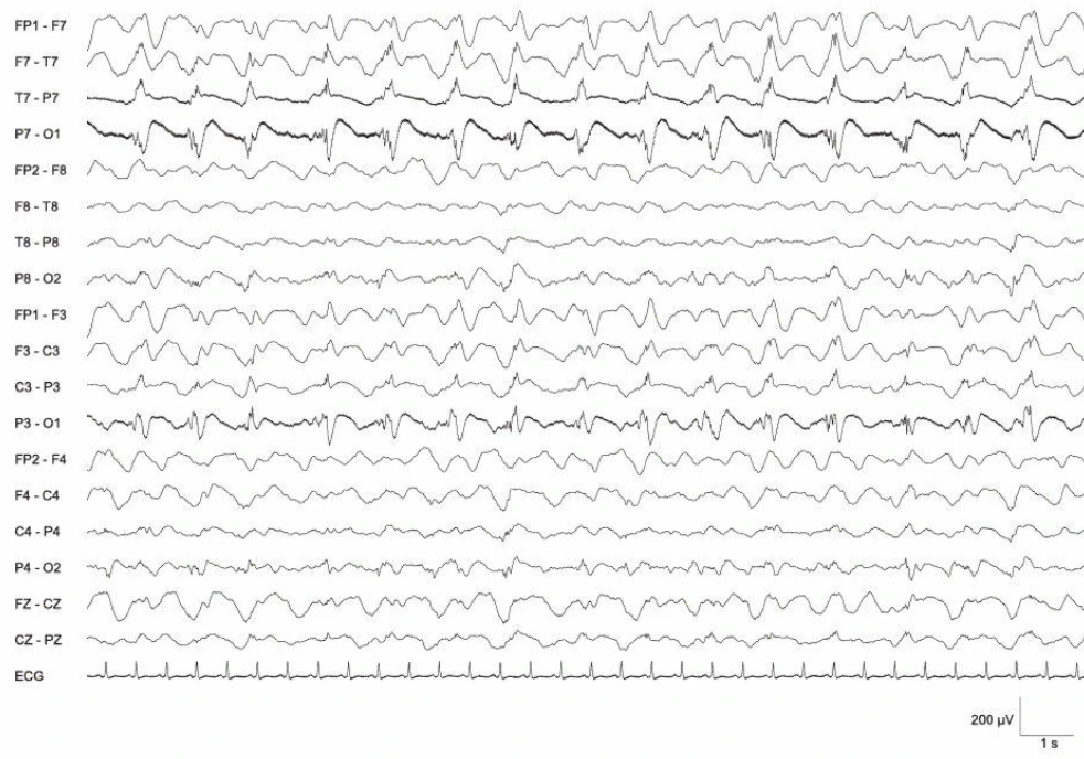 الگوی وضعیت EEG، تمپورو-اکسیپیتال چپ؛ کمای دلتا