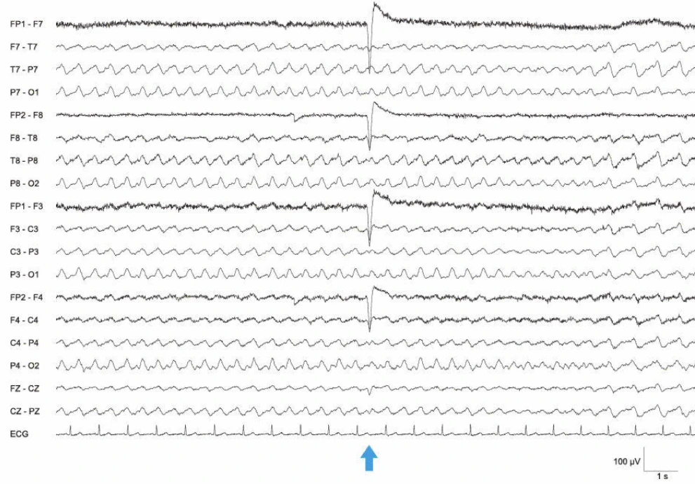 الگوی وضعیت EEG، ژنرالیزه، حداکثر اکسیپیتال