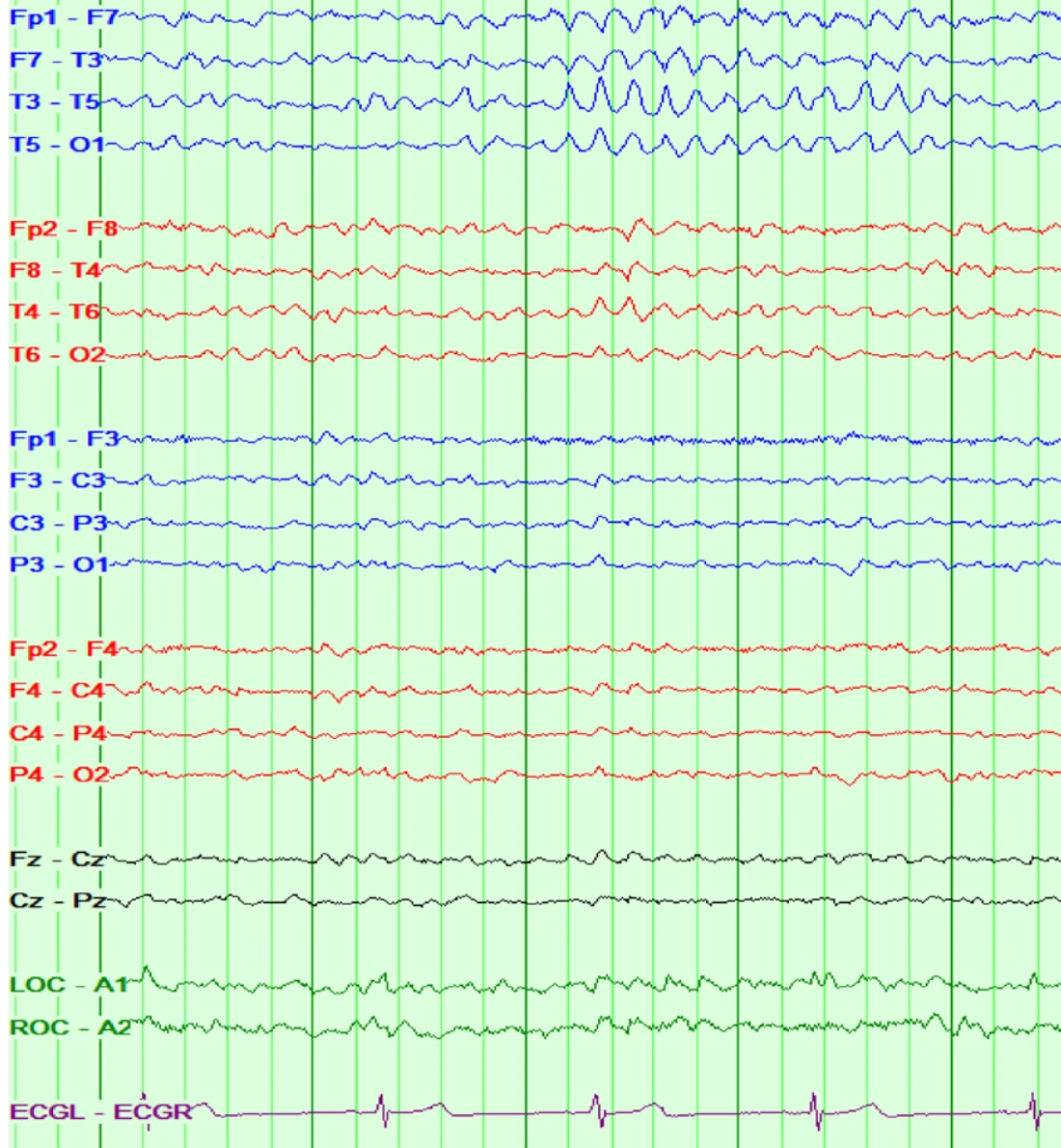 اسپایک‌های ویکت
