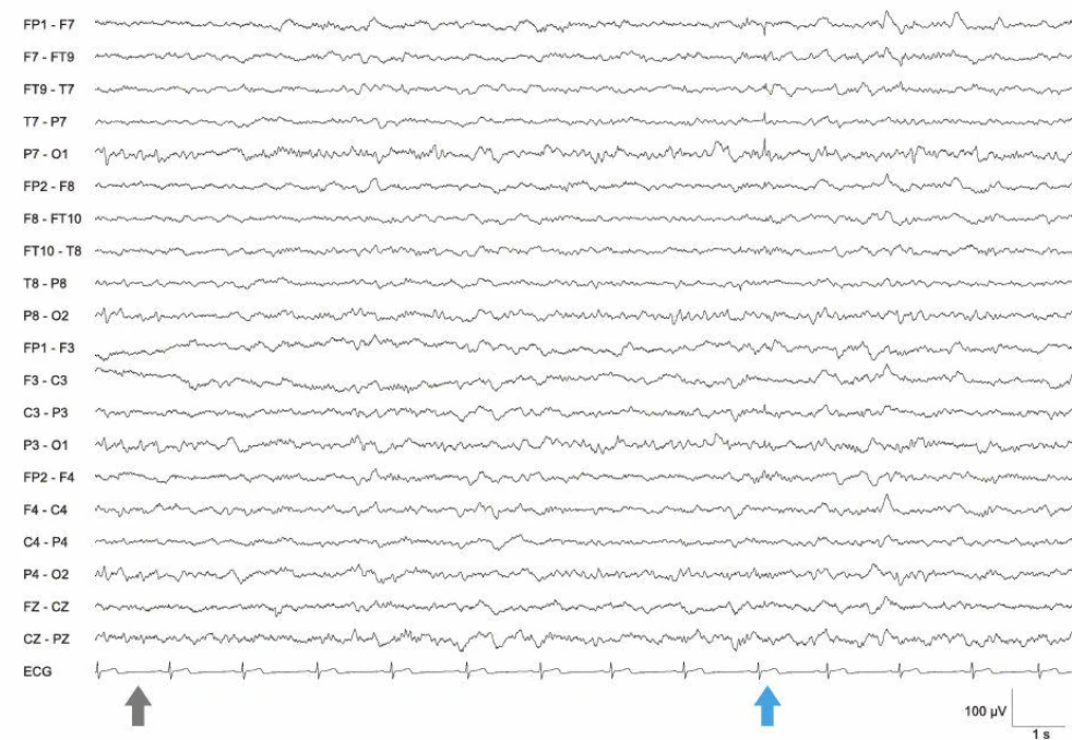 ترانزینت‌های صرعی خوش‌خیم خواب