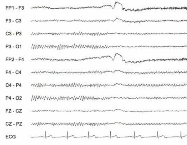 مسدود شدن ریتم مو