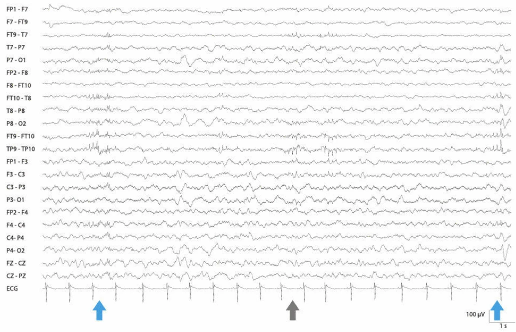اسپایک‌های مثبت 14 و 6 هرتز