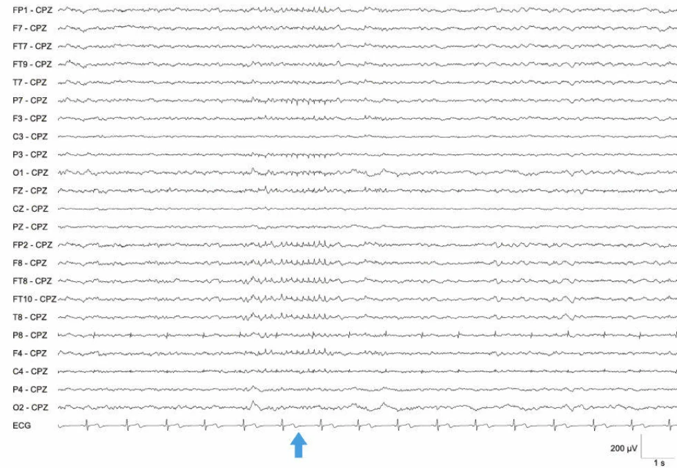 اسپایک‌های مثبت 6 هرتز