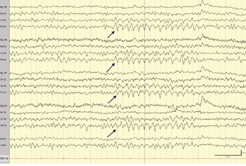 واریانت آلفا آهسته