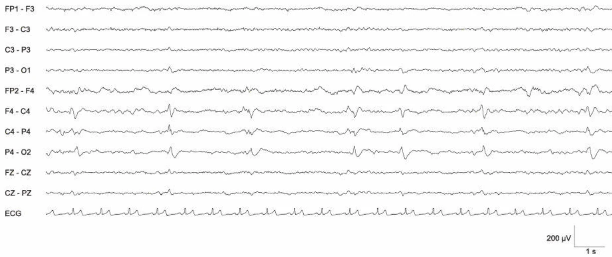 دشارژهای پریودیک، راست