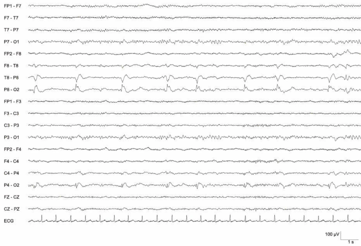 دشارژهای پریودیک اپی‌لپتی‌فرم، راست