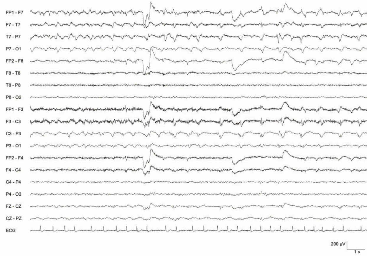 دشارژهای پریودیک، چپ