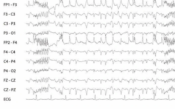دشارژهای پریودیک، ژنرالیزه