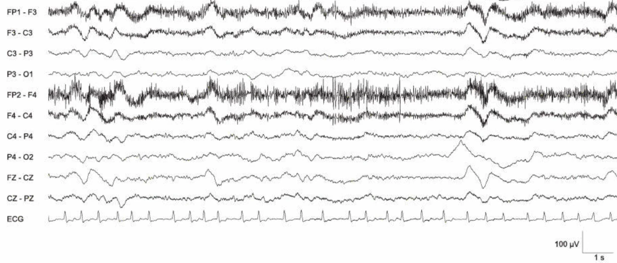 دشارژهای پریودیک، ژنرالیزه