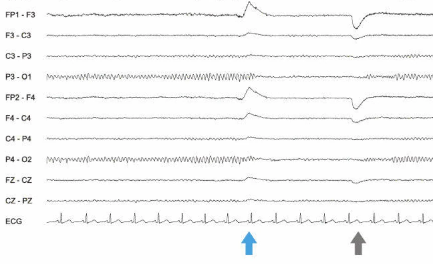 فعالیت آلفا در ناحیه پاریتو-اکسیپیتال