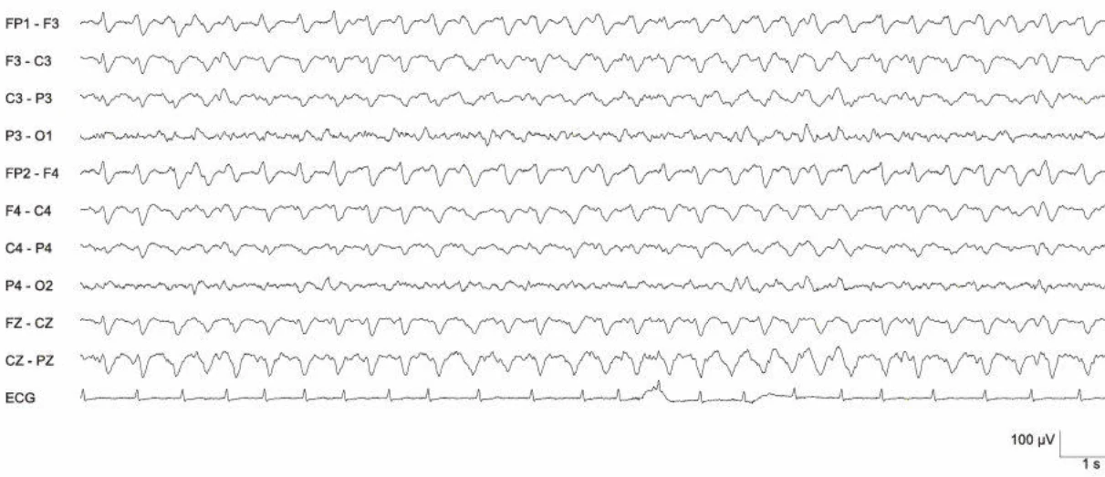 امواج تری‌فازیک (تعریف)