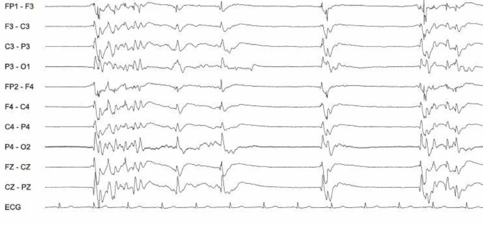 Burst-suppression، ژنرالیزه