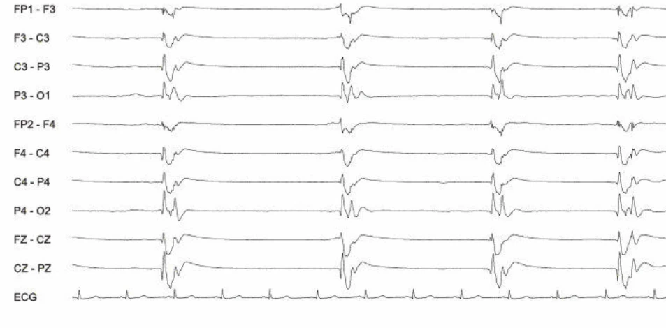 Burst-suppression، ژنرالیزه (کوتاه)