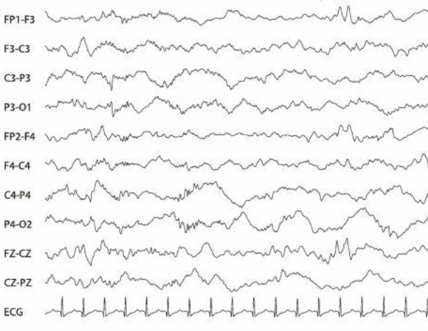 تراسه آلترنان در نوزادان