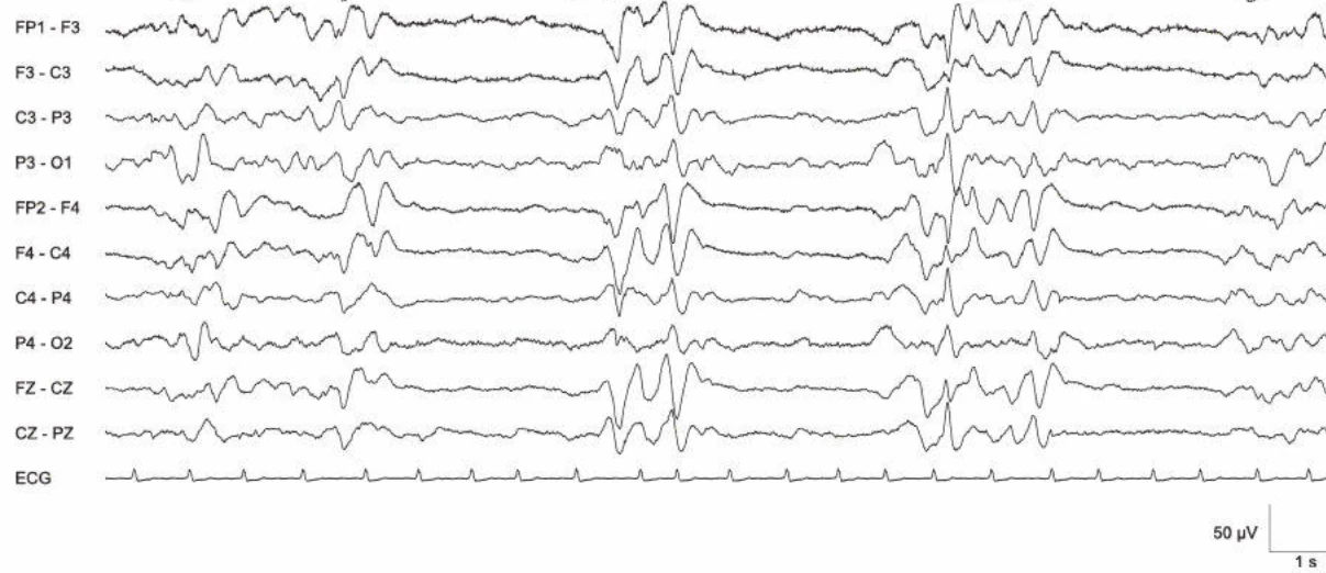 Burst-attenuation، ژنرالیزه