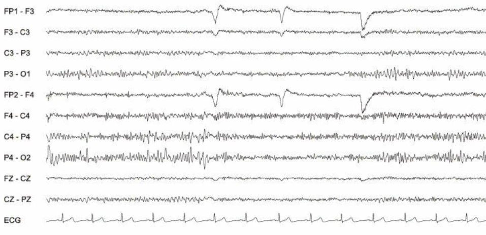 عدم تقارن، بتای افزایش‌یافته، راست