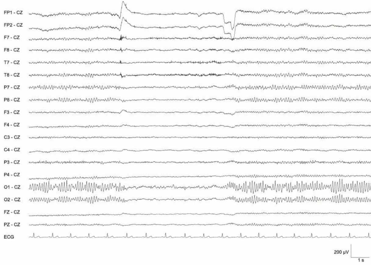 عدم تقارن، آلفای افزایش‌یافته اکسیپیتال چپ
