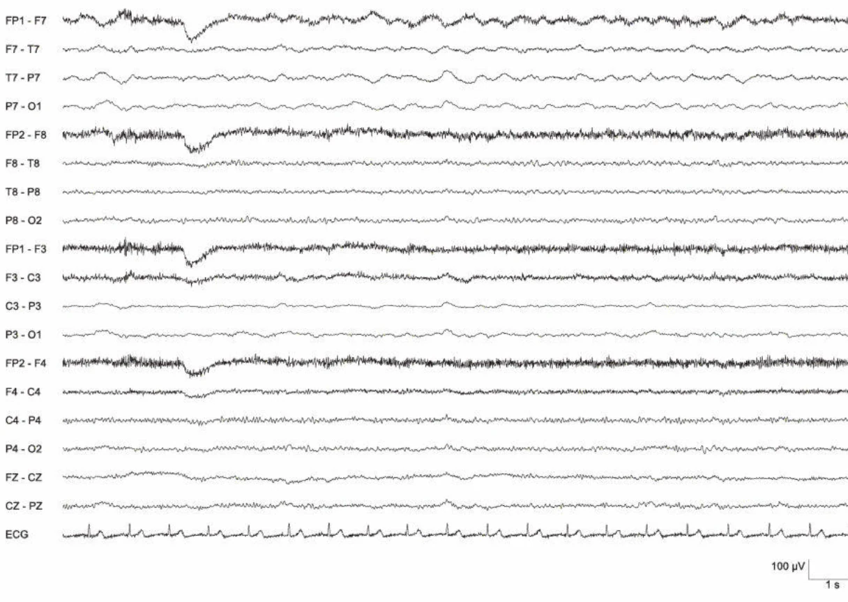 عدم تقارن، کاهش پس‌زمینه چپ