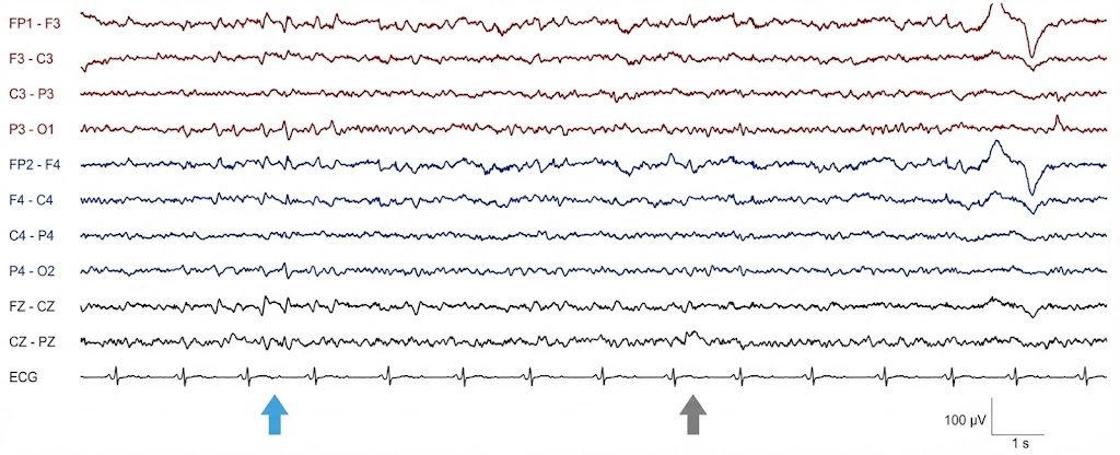 خواب REM با شروع سریع (SOREM)