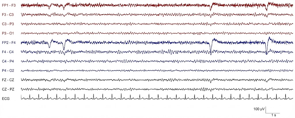 استوپور آلفا