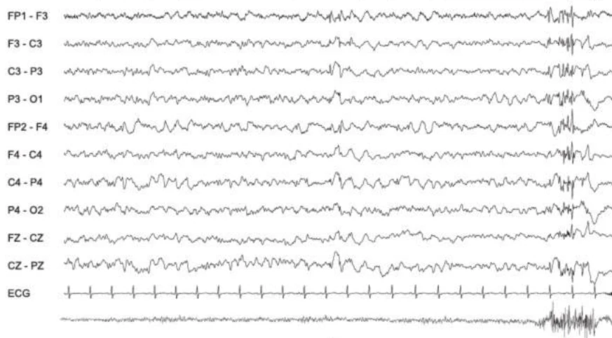 تشنج میوکلونیک