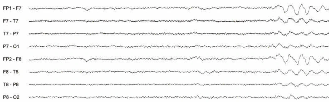 فعالیت ریتمیک دلتای فرونتال