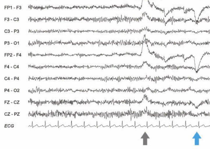 تاثیر دارو بر فعالیت بتا