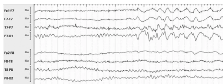 اسپایک‌ها و فعالیت دلتای ریتمیک متناوب