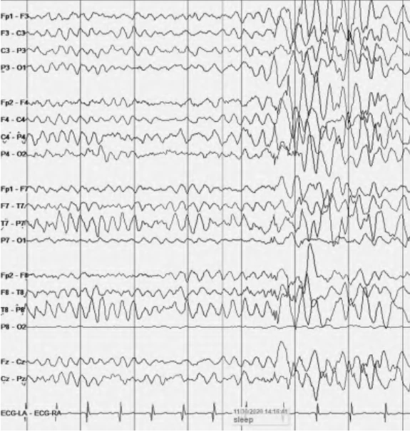 burst دلتای هیپناگوژیک