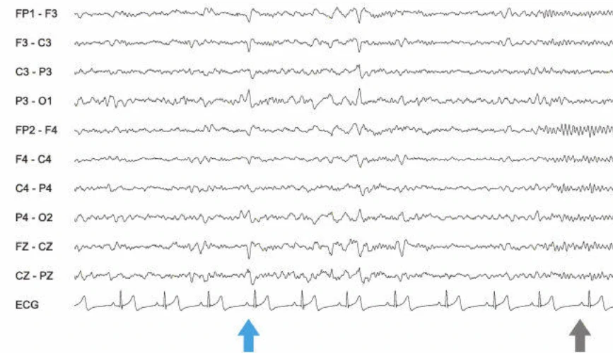 امواج ورتکس بزرگسالان