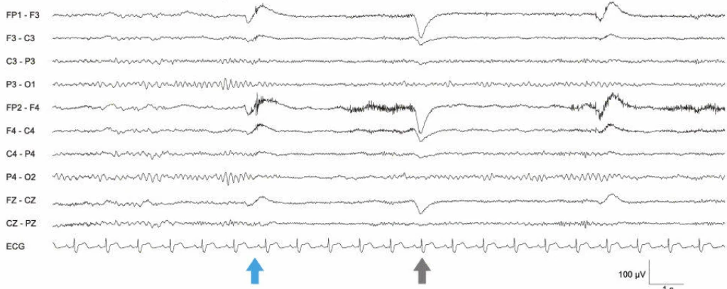 EEG غیرطبیعی درجه I