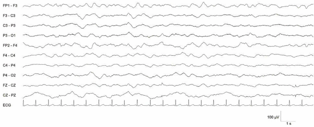 EEG غیرطبیعی درجه III