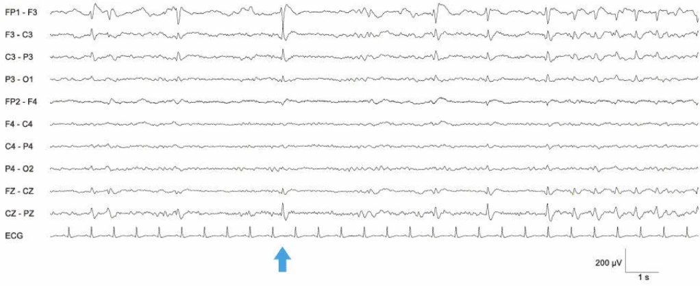 EEG با اسپایک صرعی
