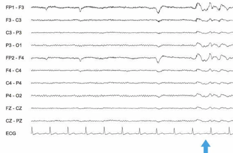 آرتیفکت گلوکینتیک