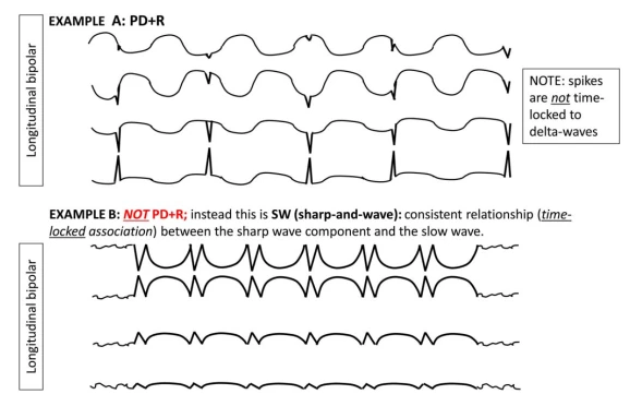 Electrographic Seizure