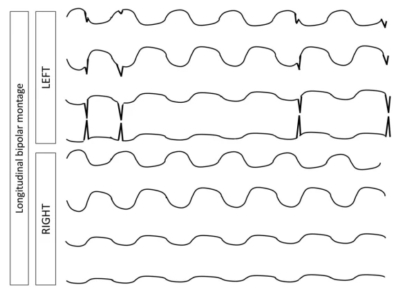 Electrographic Seizure